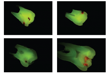 Fluorescence Aided Caries Excavation